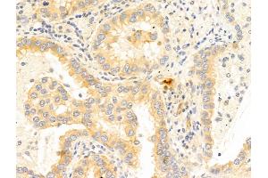 ABIN6266055 and ABIN6273350 at 1/100 staining Human lung cancer by IHC-P. (WWP1 antibody  (Internal Region))
