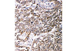 Anti-PMP70 antibody, IHC(P) IHC(P): Human Lung Cancer Tissue