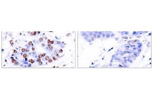 Immunohistochemical analysis of paraffin-embedded human breast carcinoma tissue using NF-κB p65 (Ab-276) antibody (E021011). (NF-kB p65 antibody)
