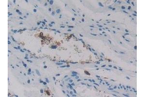 Detection of REG3g in Human Stomach cancer Tissue using Polyclonal Antibody to Regenerating Islet Derived Protein 3 Gamma (REG3g)