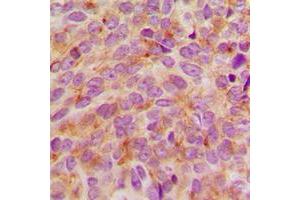Immunohistochemical analysis of STMN1 staining in human breast cancer formalin fixed paraffin embedded tissue section.