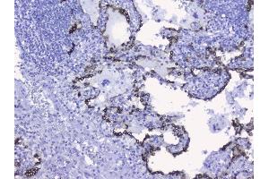 IHC analysis of Cytokeratin 19 using anti-Cytokeratin 19 antibody (ABIN3043288). (Cytokeratin 19 antibody  (C-Term))