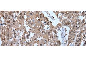 Immunohistochemistry of paraffin-embedded Human esophagus cancer tissue using ZNF787 Polyclonal Antibody at dilution of 1:45(x200) (ZNF787 antibody)
