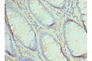 Immunohistochemistry of paraffin-embedded human colon cancer using ABIN7174493 at dilution of 1:100 (UBE2V2 antibody  (AA 1-145))