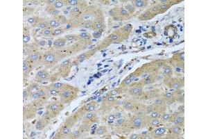 Immunohistochemistry of paraffin-embedded Human liver damage using UGT2B10 Polyclonal Antibody at dilution of 1:100 (40x lens). (UGT2B10 antibody)