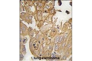 Formalin-fixed and paraffin-embedded human lung carcinoma tissue reacted with GMFG antibody (N-term) (ABIN392351 and ABIN2841990) , which was peroxidase-conjugated to the secondary antibody, followed by DAB staining. (GMFG antibody  (N-Term))