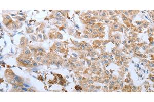 Immunohistochemistry of paraffin-embedded Human lung cancer tissue using FGF1 Polyclonal Antibody at dilution 1:50 (FGF1 antibody)