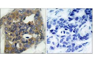 Immunohistochemical analysis of paraffin-embedded human breast carcinoma tissue, using ASK1 (phospho-Ser966) antibody (E011179). (ASK1 antibody  (pSer966))
