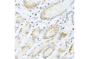 Immunohistochemistry of paraffin-embedded human gastric cancer using SULT2 Antibody (4063) at dilution of 1:200 (40x lens). (SULT2A1 antibody  (AA 1-145))