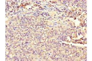 Immunohistochemistry of paraffin-embedded human cervical cancer using ABIN7163366 at dilution of 1:100 (ATP8A1 antibody  (AA 448-545))