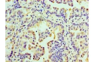 Immunohistochemistry of paraffin-embedded human lung cancer using ABIN7167634 at dilution of 1:100 (RMDN3 antibody  (AA 1-470))