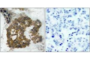 Immunohistochemistry analysis of paraffin-embedded human lung carcinoma, using Akt2 (Phospho-Ser474) Antibody.
