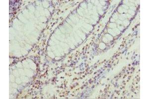 Immunohistochemistry of paraffin-embedded human colon cancer using ABIN7151256 at dilution of 1:100 (TRIM32 antibody  (AA 1-280))