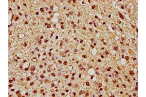 IHC image of nme1HU diluted at 1:10 and staining in paraffin-embedded human glioma cancer performed on a Leica BondTM system. (Histone H1.1 antibody  (AA 18-30))