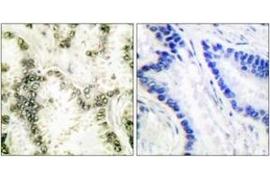Immunohistochemistry analysis of paraffin-embedded human lung carcinoma tissue, using Ku70 Antibody. (XRCC6 antibody  (AA 560-609))