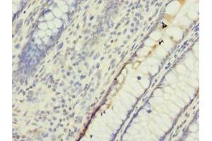 Immunohistochemistry of paraffin-embedded human colon cancer using ABIN7174232 at dilution of 1:100 (UBQLNL antibody  (AA 305-475))