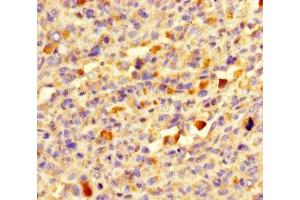 Immunohistochemistry of paraffin-embedded human melanoma using ABIN7145476 at dilution of 1:100 (DEFB104A antibody  (AA 23-72))