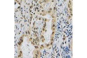 Immunohistochemical analysis of ZNF436 staining in human lung cancer formalin fixed paraffin embedded tissue section.