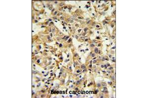 CA6 Antibody IHC analysis in formalin fixed and paraffin embedded breast carcinoma followed by peroxidase conjugation of the secondary antibody and DAB staining.