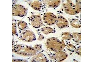FAT10 antibody immunohistochemistry analysis in formalin fixed and paraffin embedded human stomach carcinoma. (UBD antibody  (AA 120-153))