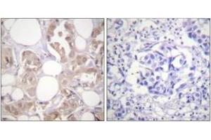 Immunohistochemistry analysis of paraffin-embedded human breast carcinoma, using CDK7 (Phospho-Thr170) Antibody. (CDK7 antibody  (pThr170))