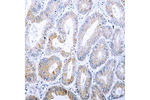 Immunohistochemical analysis of Cytokeratin 18 (pS33) staining in human colon cancer formalin fixed paraffin embedded tissue section. (Cytokeratin 18 antibody  (N-Term, pSer33))