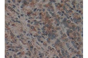 Detection of CNX in Human Prostate cancer Tissue using Polyclonal Antibody to Calnexin (CNX) (Calnexin antibody  (AA 239-461))