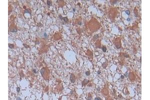Detection of PLA2G4 in Human Glioma Tissue using Monoclonal Antibody to Cytosolic Phospholipase A2 (PLA2G4) (PLA2G4A antibody  (AA 1-178))