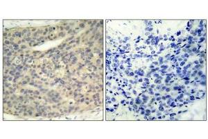 Immunohistochemical analysis of paraffin-embedded human breast carcinoma tissue using LIMK1(Phospho-Thr508) Antibody(left) or the same antibody preincubated with blocking peptide(right). (LIM Domain Kinase 1 antibody  (pThr508))
