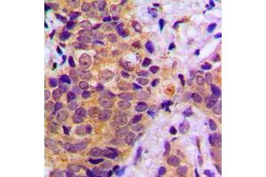 Immunohistochemical analysis of B-RAF staining in human prostate cancer formalin fixed paraffin embedded tissue section. (SNRPE antibody  (C-Term))
