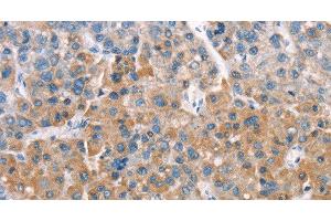 Immunohistochemistry of paraffin-embedded Human liver cancer tissue using LATS2 Polyclonal Antibody at dilution 1:30 (LATS2 antibody)