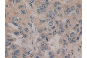 Detection of ENPEP in Human Breast cancer Tissue using Polyclonal Antibody to Aminopeptidase A (ENPEP) (ENPEP antibody  (AA 718-948))