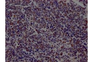 IHC image of ABIN7127456 diluted at 1:100 and staining in paraffin-embedded human lung cancer performed on a Leica BondTM system. (Recombinant LIG1 antibody)