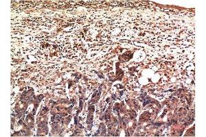 Immunohistochemical analysis of paraffin-embedded Human Stomach Carcinoma Tissue using Ubiquitin Mouse mAb diluted at 1:200. (Ubiquitin antibody)