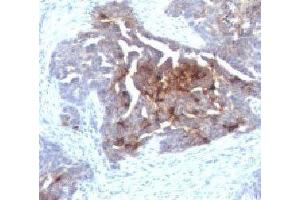 IHC testing of human ovarian carcinoma with TAG-72 antibody. (TAG-72 antibody)