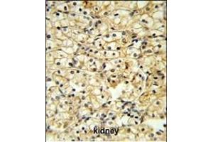 TR Antibody (C-term) 6545b IHC analysis in formalin fixed and paraffin embedded kidney carcinoma followed by peroxidase conjugation of the secondary antibody and DAB staining. (CD40 Ligand antibody  (C-Term))