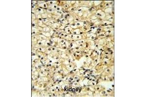 TR Antibody (C-term) 6545b IHC analysis in formalin fixed and paraffin embedded kidney carcinoma followed by peroxidase conjugation of the secondary antibody and DAB staining. (CD40 Ligand antibody  (C-Term))