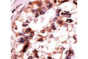 IHC analysis of FFPE human hepatocarcinoma tissue stained with the ERK3 antibody. (MAPK6 antibody  (pSer189))
