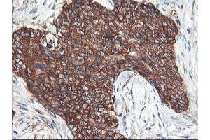 Immunohistochemical staining of paraffin-embedded Adenocarcinoma of Human breast tissue using anti-PFKP mouse monoclonal antibody. (PFKP antibody)