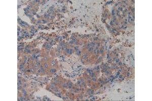 IHC-P analysis of Human Breast Cancer Tissue, with DAB staining. (alpha Actinin 4 antibody  (AA 1-269))