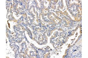 ABIN7095207 and ABIN7099263 at 1/100 staining human liver cancer by IHC-P.