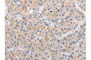 The image on the left is immunohistochemistry of paraffin-embedded Human liver cancer tissue using ABIN7128506(ARHGEF9 Antibody) at dilution 1/50, on the right is treated with fusion protein. (Arhgef9 antibody)