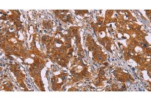 Immunohistochemistry of paraffin-embedded Human gasrtic cancer tissue using DCTN6 Polyclonal Antibody at dilution 1:40 (DCTN6 antibody)