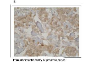 Immunohistochemistry staining of prostate cancer tissue using CYP3A7 antibody. (CYP3A7 antibody  (C-Term))