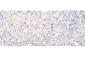 Immunohistochemistry of paraffin-embedded Human cervical cancer tissue using SLC25A27 Polyclonal Antibody at dilution of 1:30(x200) (SLC25A27 antibody)