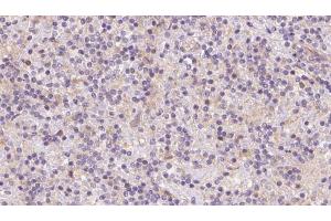 ABIN6273083 at 1/100 staining Human lymph cancer tissue by IHC-P.