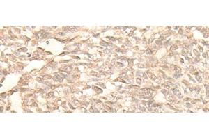 Immunohistochemistry of paraffin-embedded Human lung cancer tissue using RAD23B Polyclonal Antibody at dilution of 1:25(x200) (RAD23B antibody)