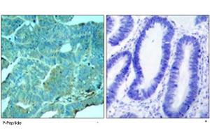 Immunohistochemical analysis of paraffin-embedded human colon carcinoma tissu using EIF2AK2 (phospho T446) polyclonal antibody . (EIF2AK2 antibody  (pThr446))