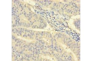 Immunohistochemistry of paraffin-embedded human endometrial cancer using ABIN7156965 at dilution of 1:100 (ISX antibody  (AA 1-245))