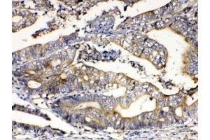 IHC testing of FFPE human intestinal cancer tissue with Calpain 2 antibody at 1ug/ml.
